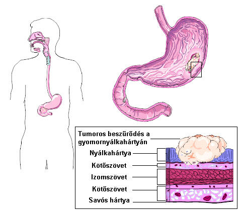 gyomorrák új kezelés