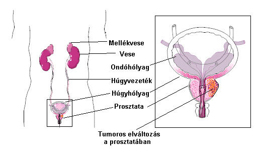 krónikus prosztatitis kezelése után