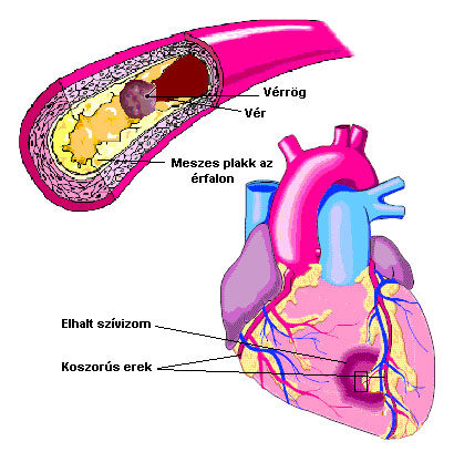 dohányzáskor a szív és az erek betegségei)