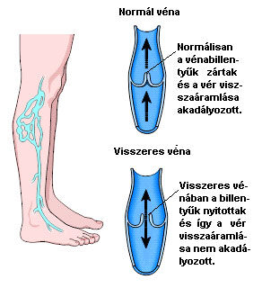 visszér elsődleges és másodlagos)