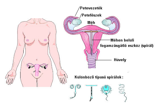 fogyni iud eltávolítása után