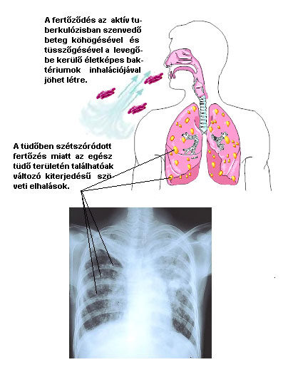 tuberkulózis fogyni