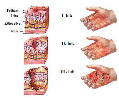 Égési sérülés a kézfejen; Kép forrása: http://www.burn-recovery.org
