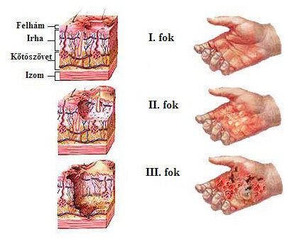 ii fokú égési sérülés gyógyulása
