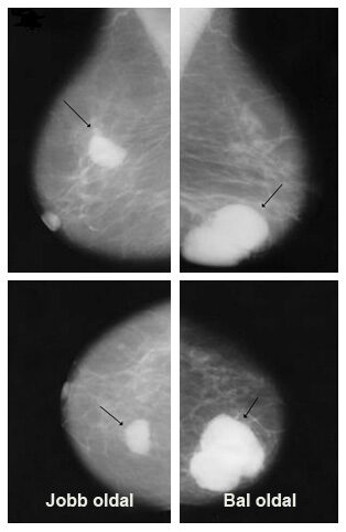 A képen mammográf felvétel látható, amelyen a nyilak a tumoros elváltozásra mutatnak rá