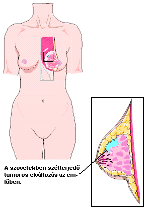 Így dolgoznak benned a BRCA1 és BRCA2 gének - lesd meg, mit művelnek!