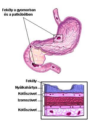 a gyomorfekélyek kezelésének cukorbetegsége)