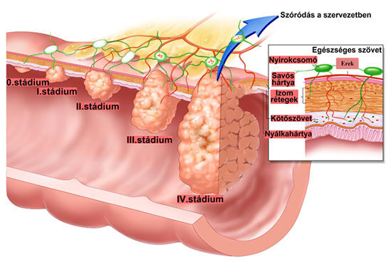 vastagbélrák 3. szint