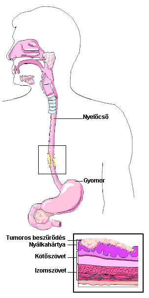 nyelőcső betegség