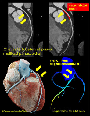 Fotonszámláló CT-vel készült felvétel koszorúerekről; Kép forrása: Semmelweis Egyetem Orvosi Képalkotó Klinika