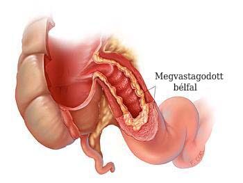 crohn betegség fogyás)