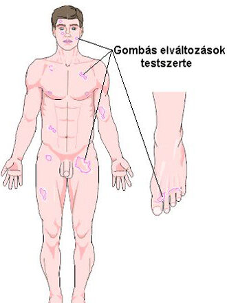 Gombás elváltozások testszerte Gombás elváltozások testszerte