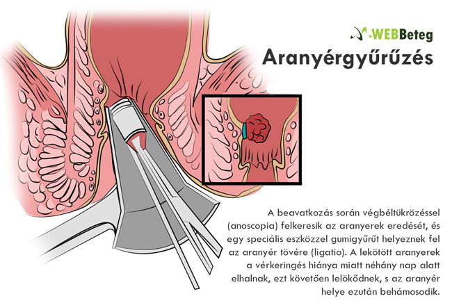 Aranyér kezelése cukorbetegség esetén