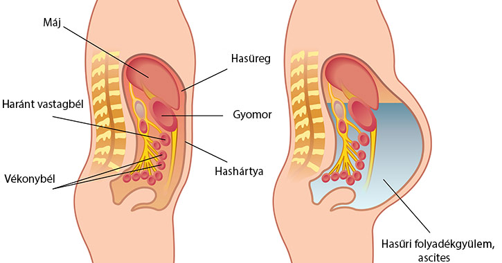 Hasűri folyadékgyülem, ascites