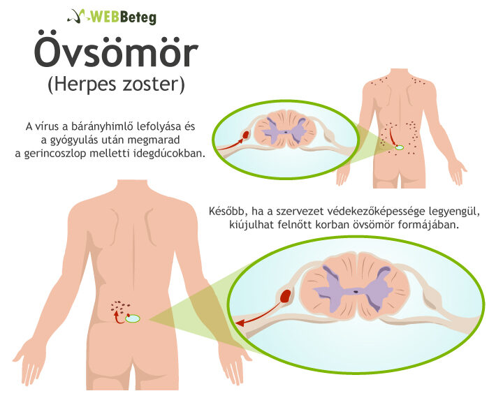 Herpes zoster (övsömör) kialakulása és a kiütések