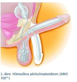 péniszimplantátum