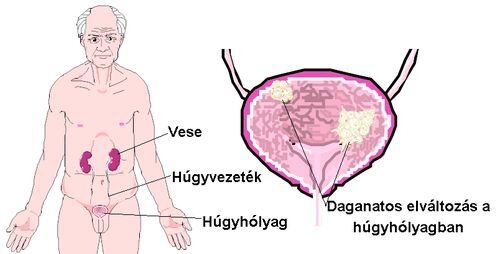 Húgyhólyag daganat