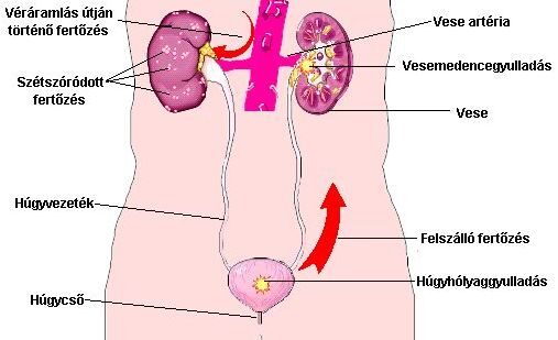 húgyuti fertőzések