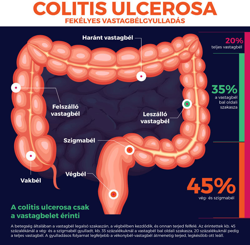KATTINTSON A KÉPRE! - Colitis ulcerosa infografika