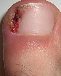 a körmök kezelése a lábakon a lábakon zokni körömgomba kezelésére