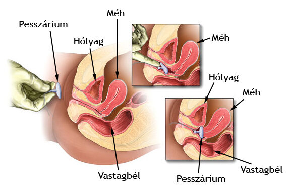 Prosztata felfüggesztés a húgyhólyagban