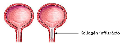 Hólyagnyak megerősítése kollagén injekcióval