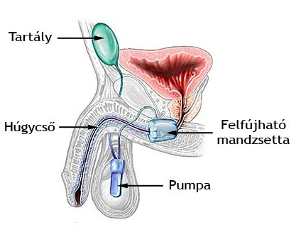 prosztata tampon kezelés prostatitis mri dwi