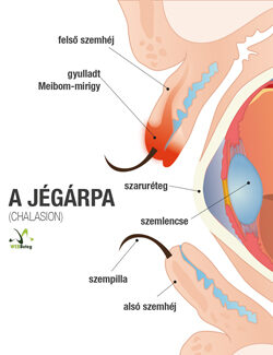 Jégárpa (chalasion)