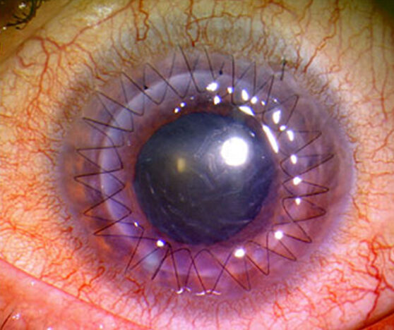 szaruhártya-transzplantáció és látás
