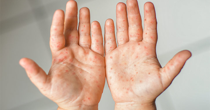 Kéz-láb-száj betegség - A kézen kiütések