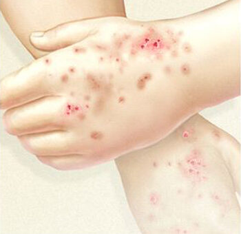 A légúti allergia fajtái és tünetei