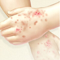 Eucerin®: A bőrről | Bőrgyulladás utáni hiperpigmentáció