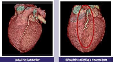 koszorúér-betegség egészségügyi szív információk)