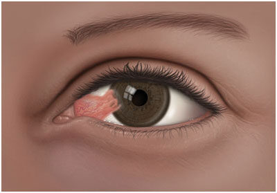 pterygium és látás g kapuk javítják a látást anélkül