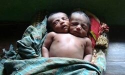Kétfejű bangladesi kisfiú született
