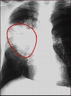 Tüdőtumor röntgenfelvételen; Forrás: www.nlm.nih.gov