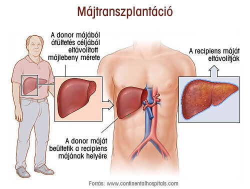 Májtranszplantáció