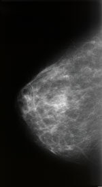 Mammográfia - Egészséges mell