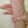 Marfan-szindróma: A beteg kisujjával átéri a csuklóját