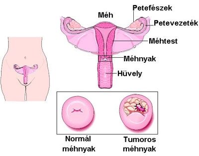 endometrium rák előfordulása csökken a lábujjak között