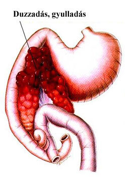 a krónikus hasnyálmirigy-gyulladás kezelésére a diabetes