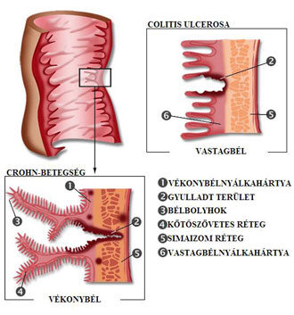A bél ismeretlen eredetű gyulladásos megbetegedései (colitis ulcerosa, Crohn-betegség); Kép forrása: https://www.internisten-im-netz.de/
