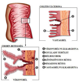 Mi a Crohn betegség?