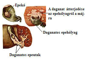 Jelek, amelyek epehólyag-gyulladásra utalnak