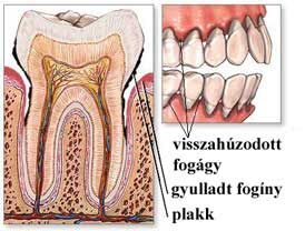 periodontális betegek kezelésére diabetes mellitus)