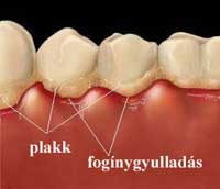 fogak és íny betegségei a dohányzástól)