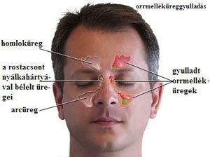 kronikus arcureg gyulladas gyógyszer csípőízületi kezelés