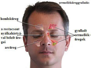 Orrmelléküregek elhelyezkedése és gyulladása; Kép forrása: https://www.nlm.nih.gov