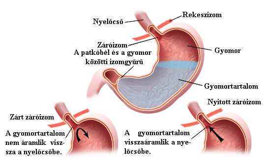 A reflux betegség ábra