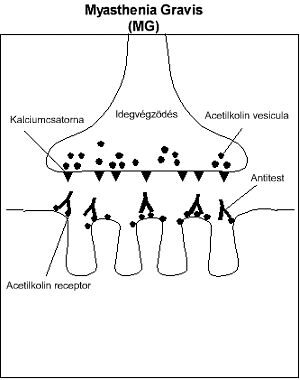 myasthenia gravis és látás)